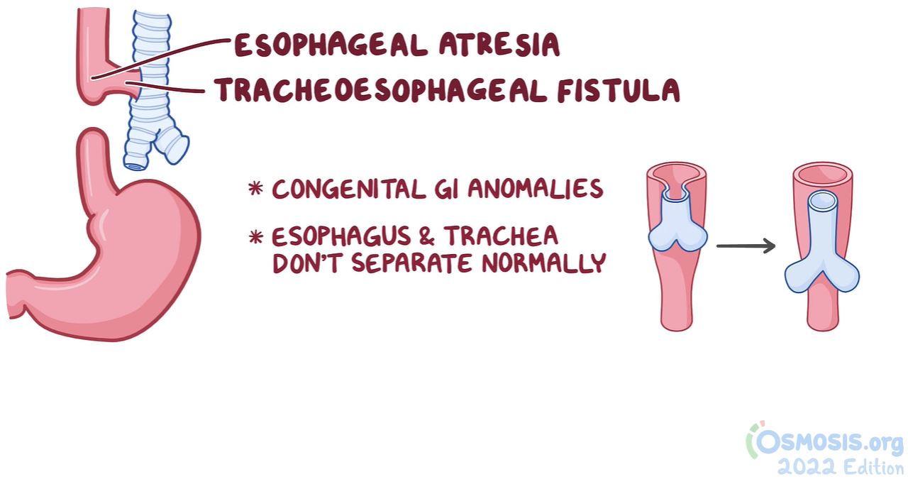 Diagram of Esophageal Atresia & Tracheoesophageal Fistula