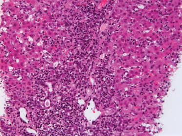 Typical histological findings of autoimmune hepatitis showing marked lymphoplasmacellular infiltration of the portal tract with interface hepatitis.