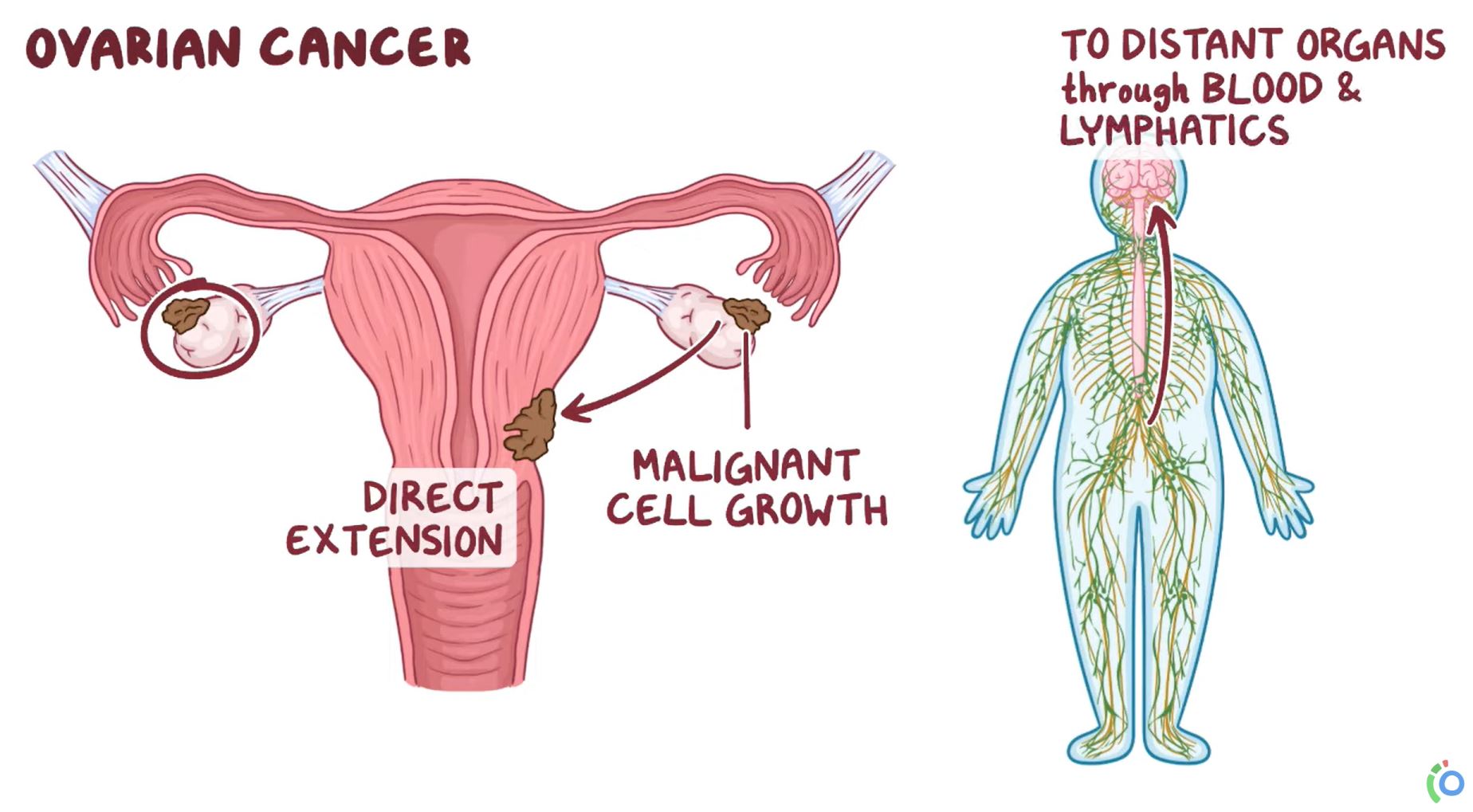 Diagram of ovarian cancer