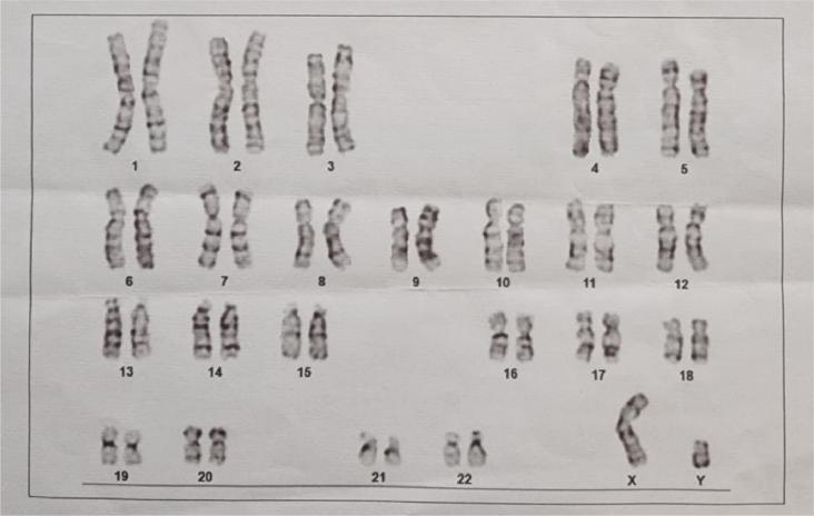 Chromosomal examination revealed a 46XY karyotype pattern.