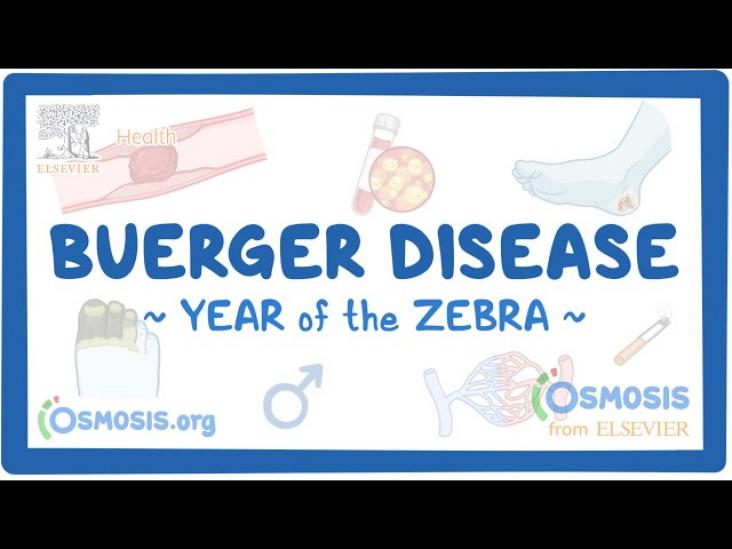 Rare Disease Education: Buerger Disease