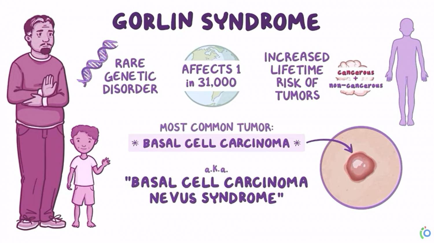 Graphic of gorlin syndrome