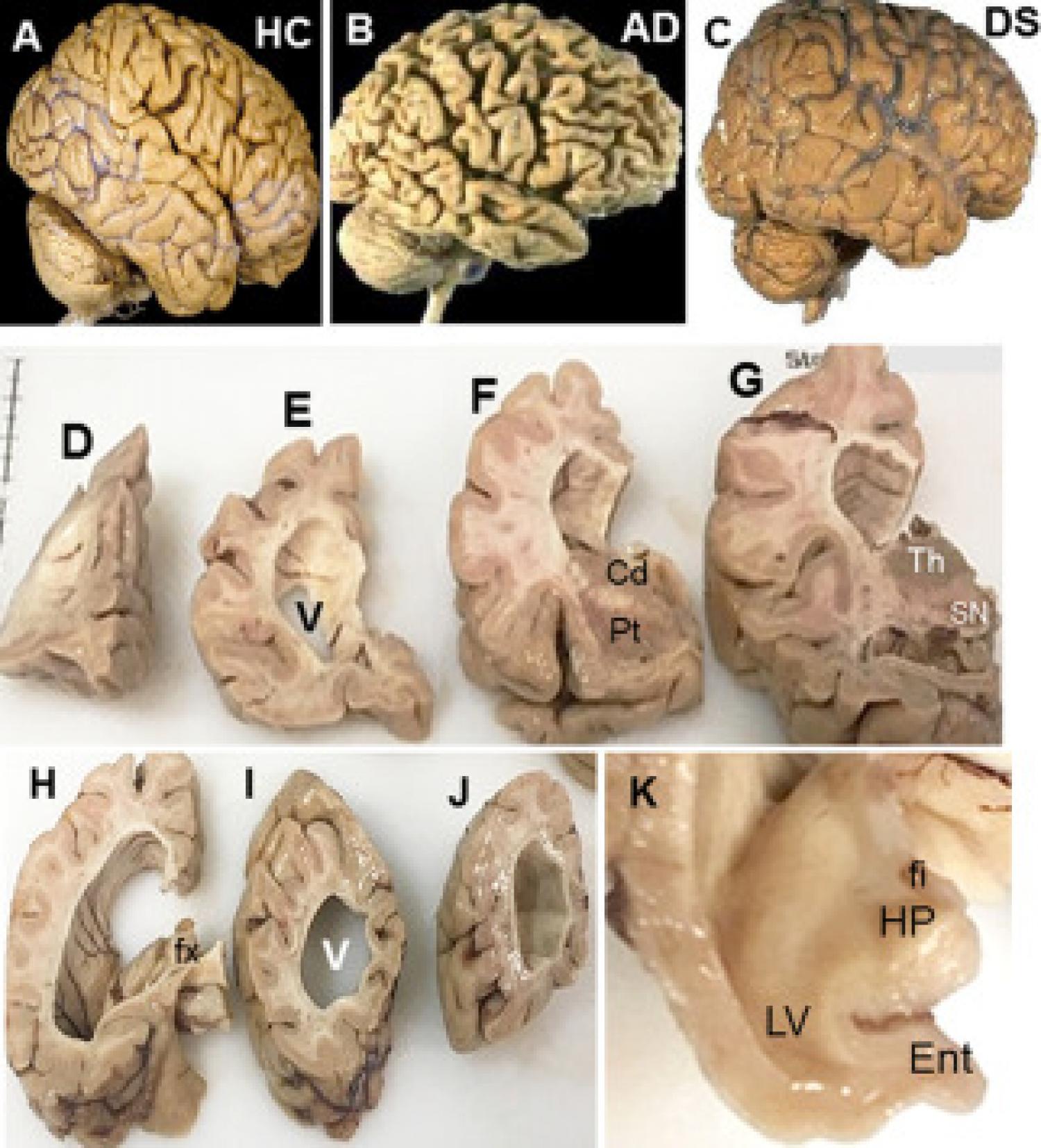 plaque-filled brains