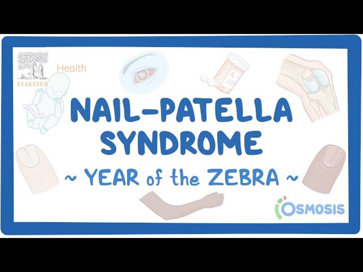 Nail patella syndrome: Causes, symptoms, treatment, inheritance