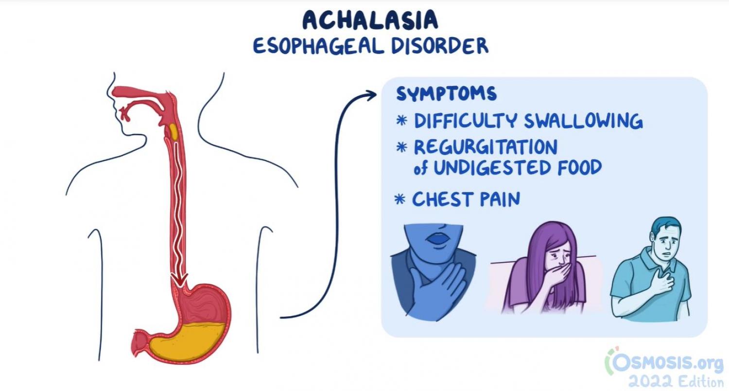 Diagram Achalasia