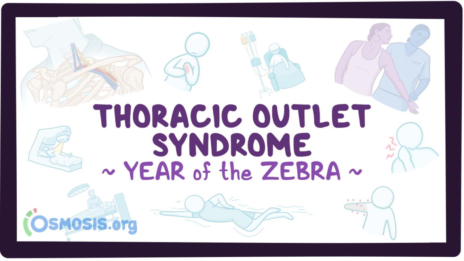 Thoracic Outlet Syndrome