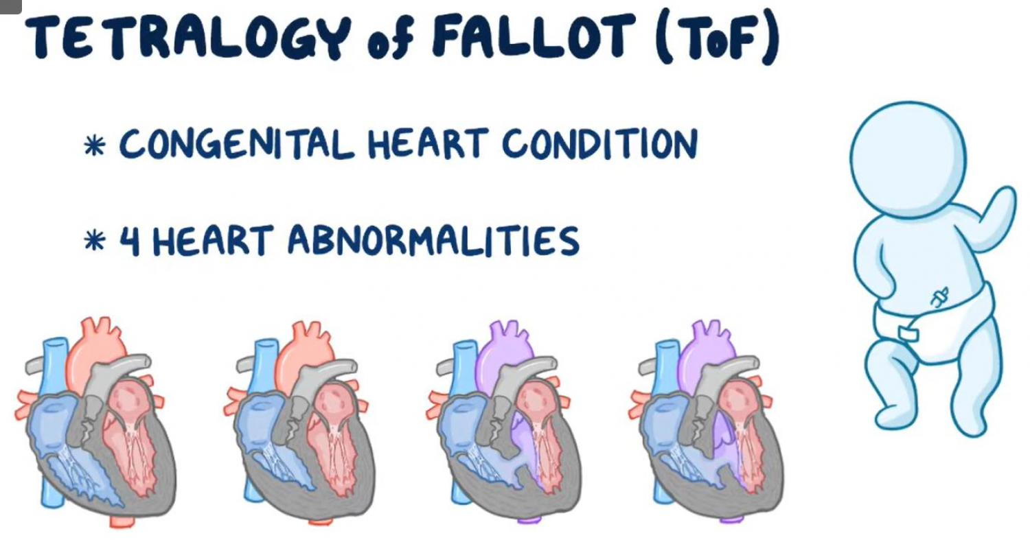 Description of tetralogy of fallot