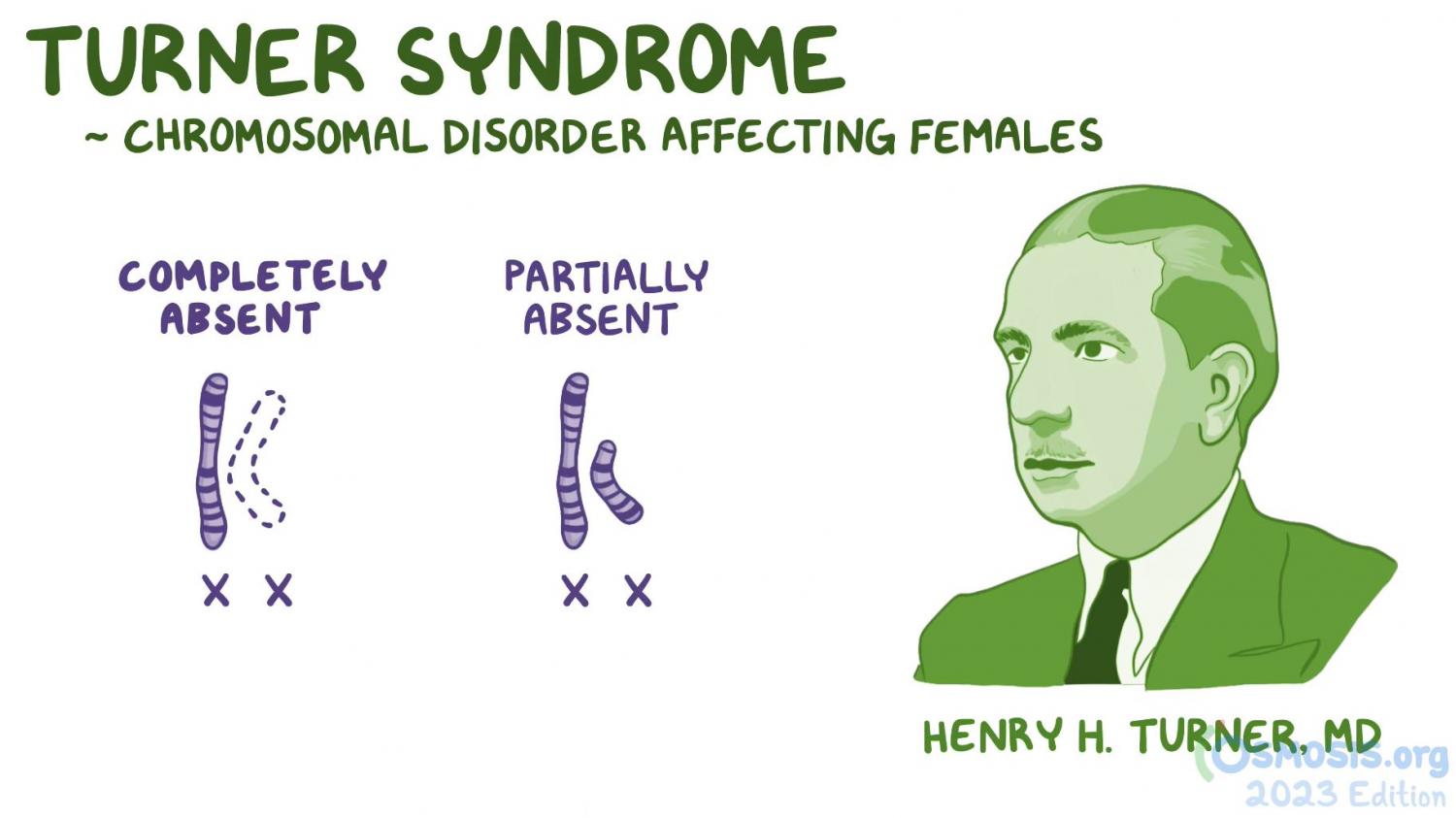 Diagram of Turner Syndrome
