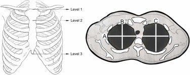 Measured thoracic levels and distances on axial CT images
